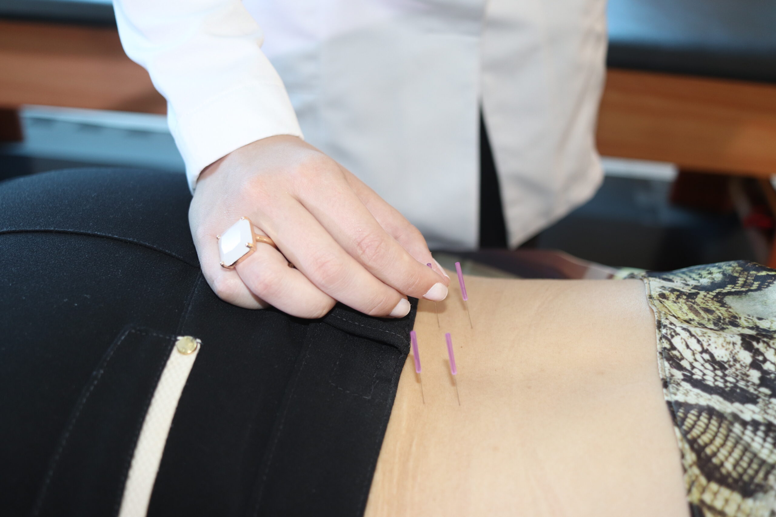 dry_needling